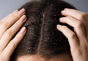 శీతాకాలంలో చుండ్రు పెరుగుతోందా...ఈ మిస్టేక్స్ చేస్తున్నట్టే..!